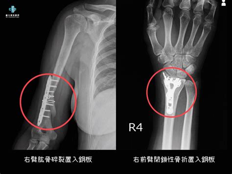 手張不開|骨折後手張不開沒有力氣骨折手術後手張不開及無力原因分析